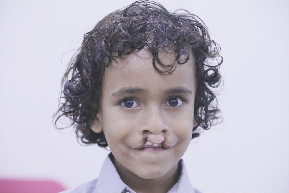 Bilal smiling before cleft surgery