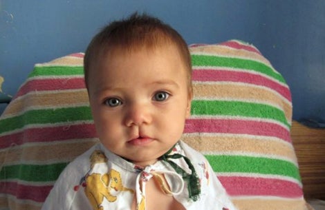 baby before cleft lip surgery