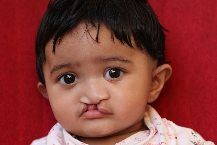 child with untreated cleft lip from Dubai